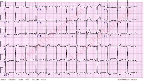 lvh with strain pattern ecg